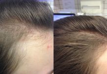 Как восстановить волосы после коронавируса