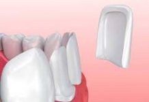 Разновидности зубных виниров