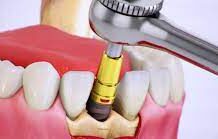 Что представляет собой двухэтапная имплантация зубов?