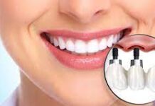 Когда нужно делать имплантацию зубов?