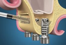 Сколько стоит синус лифтинг