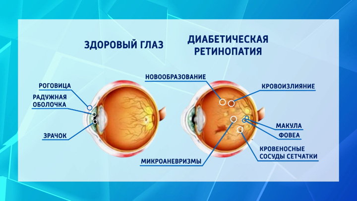 Врачи назвали самые ранние признаки диабета