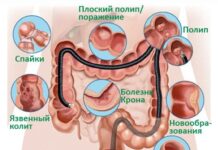 Колоноскопия: когда назначается и как проводится