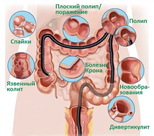 Колоноскопия: когда назначается и как проводится