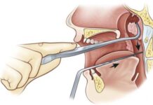 Удаление аденоидов у детей