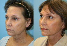 Лифтинг лица при помощи нитей MINT: особенности проведения процедуры