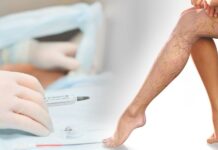 Современные способы лечения варикоза