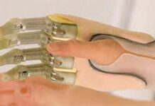 Экзопротезирование — показания к экзопротезированию, виды протезов