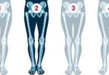 Зачем нужна коррекция формы ног, выпрямление кривизны и удлинение ног