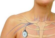 Как проходит и зачем нужна имплантация венозного порта