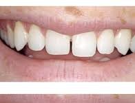 Художественная реставрация зубов для устранения щелей: Пошаговое руководство