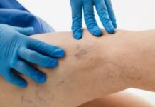 ЭВЛК: инновационный метод лечения варикозной болезни с помощью эндовазальной лазерной коагуляции