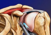 Повреждение Банкарта