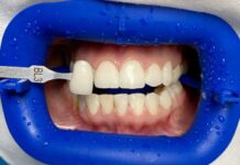 Отбеливание ZOOM 4: секреты белоснежной улыбки, о которых вы не знали