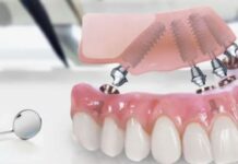 Протезирование All-on-4: что входит в стоимость