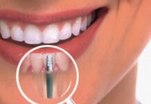 Одномоментная имплантация: быстрое и безопасное восстановление зубов