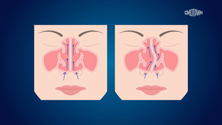 Когда необходимо оперировать искривленную носовую перегородку - Новости на Вести.ru