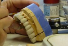 Подготовка к винирам: что нужно сделать перед установкой ортопедической конструкции