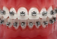 Брекеты здесь и сейчас: преимущества оплаты в рассрочку