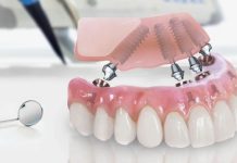 Восстановление зубов на имплантах: ваша улыбка без компромиссов