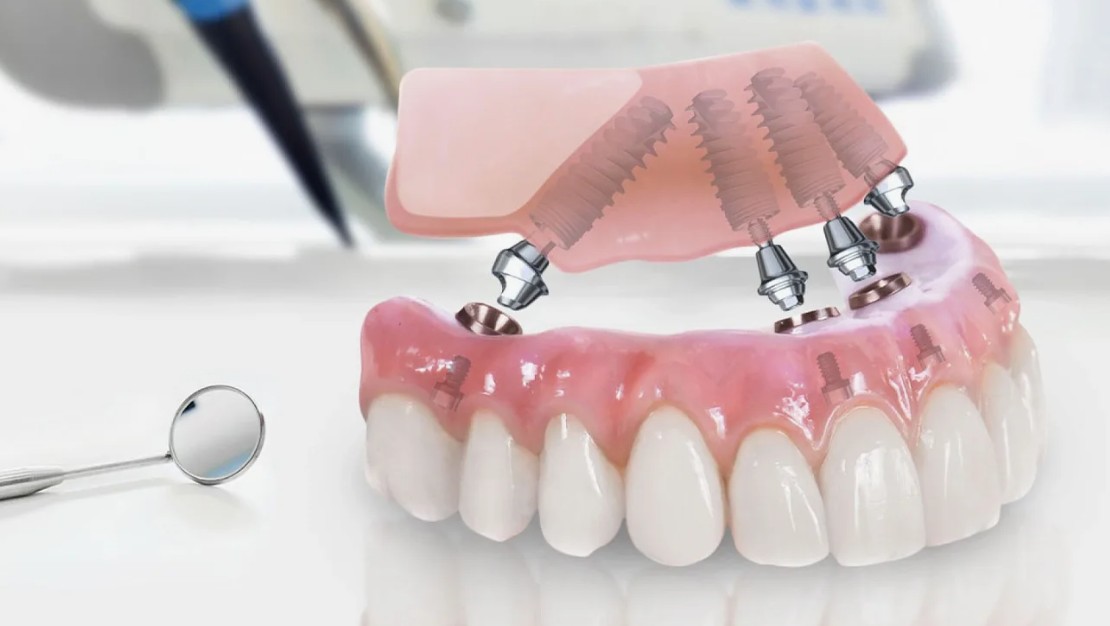 Восстановление зубов на имплантах: ваша улыбка без компромиссов