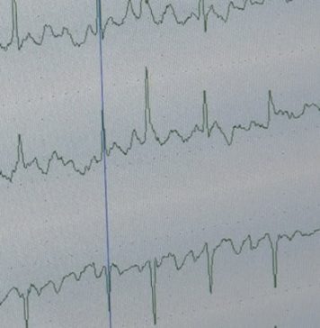 Холтер: как маленький прибор раскрывает тайны сердца — Новости на Вести.ru
