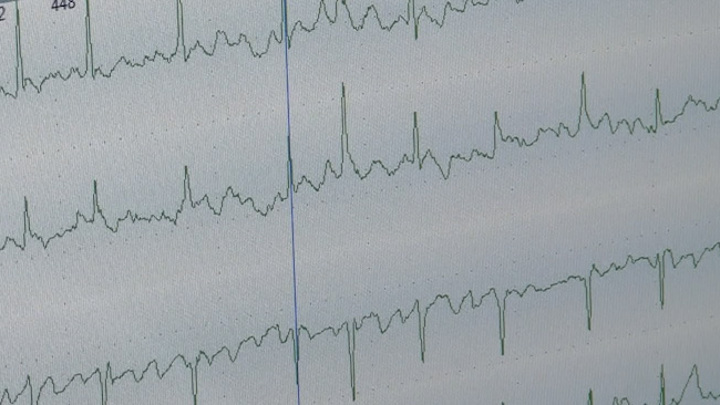 Холтер: как маленький прибор раскрывает тайны сердца — Новости на Вести.ru