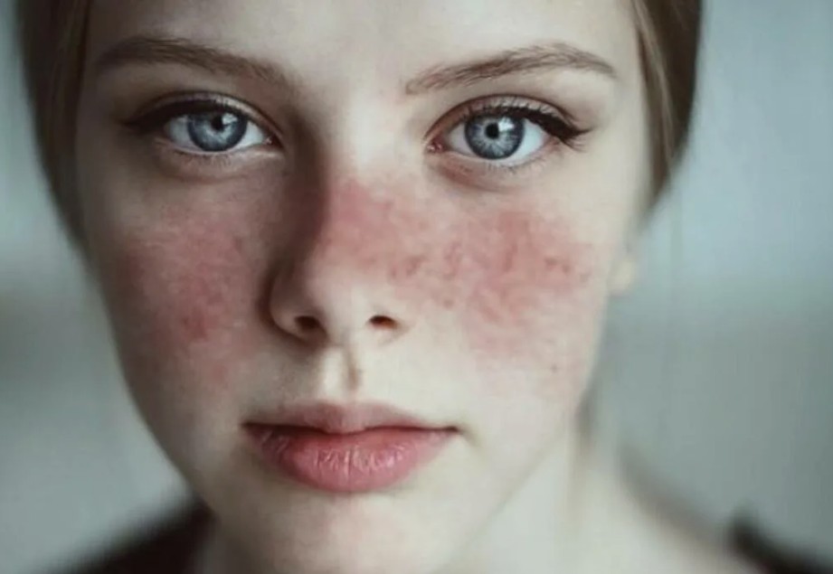 Системная красная волчанка: что это за болезнь?