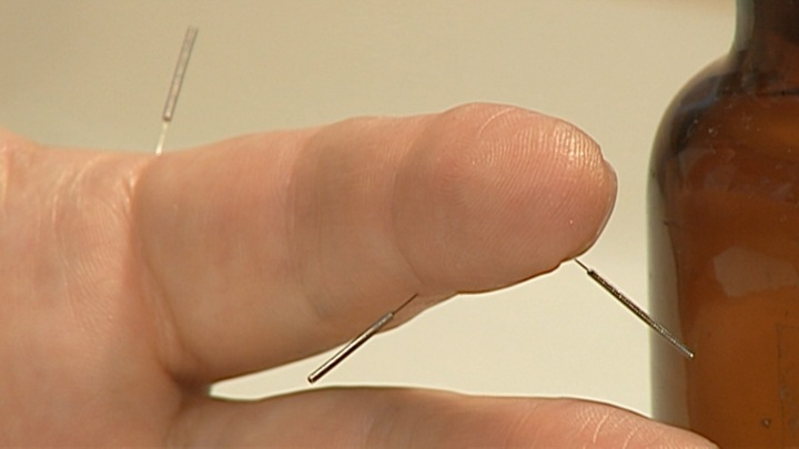 Врач Олейников рассказал, чем опасно иглоукалывание у непроверенных лекарей — Новости на Вести.ru