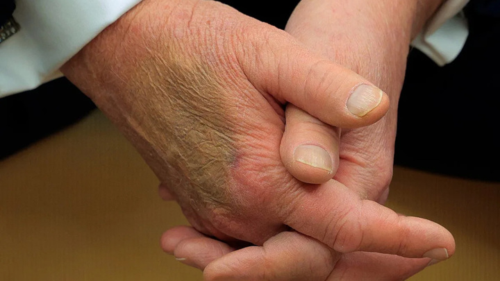 CNN: новые синяки на руке Трампа вызывают вопросы - Новости на Вести.ru